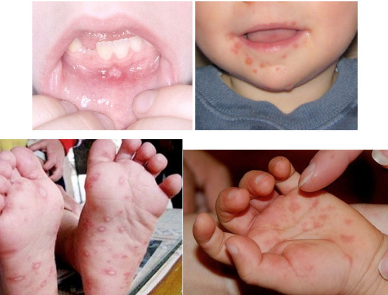 Tay chân miệng là bệnh truyền nhiễm thường gặp ở trẻ em.