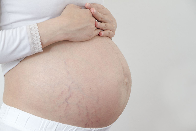 Các vết rạn da tại bụng, mông, đùi, cánh tay,… sẽ dần xuất hiện khi mẹ bước sang tuần thai thứ 22