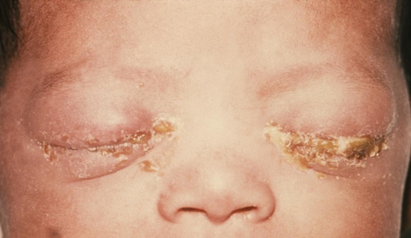 Hình ảnh trẻ sơ sinh bị nhiễm lậu 