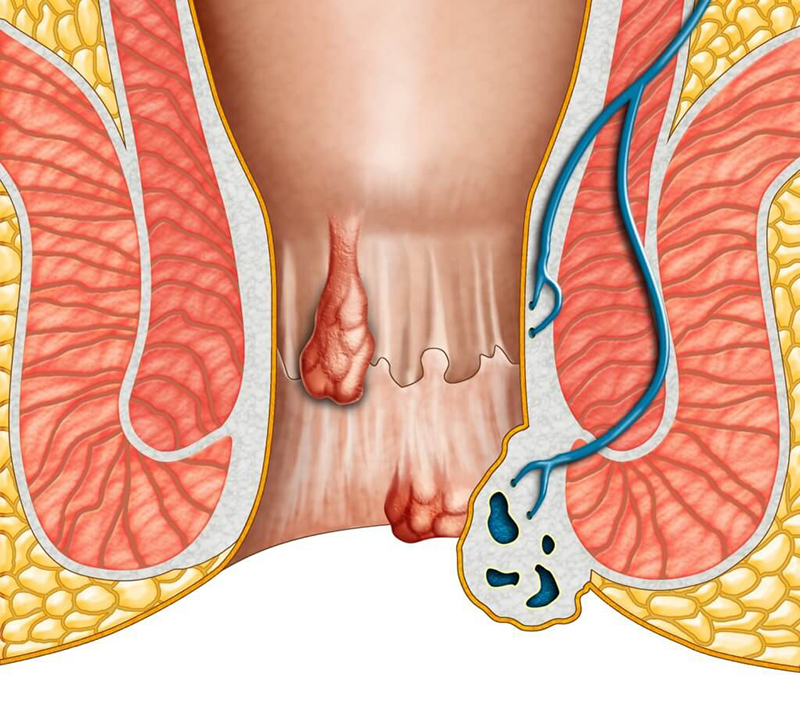 Trĩ là tình trạng các búi trĩ xuất hiện trong và ngoài ống hậu môn