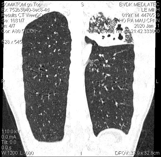 Hình ảnh chụp CT lồng ngực rõ nét, giúp phát hiện chính xác tổn thương