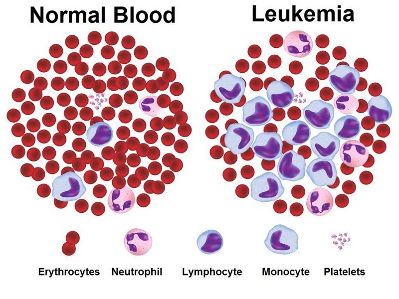 Hình 2: Hình ảnh tế bào máu bình thường và bất thường trong bệnh lý máu ác tính
