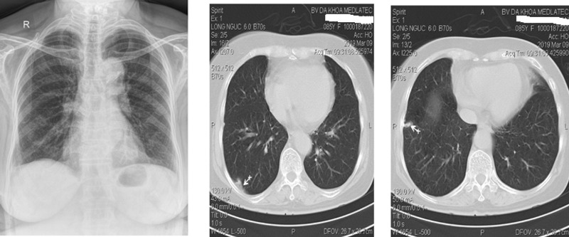 <a href='https://medlatec.vn/tin-tuc/truoc-khi-chup-ct-phoi-nhat-dinh-ban-phai-biet-dieu-nay-s154-n18748'  title ='Chụp CT phổi'>Chụp CT phổi</a>