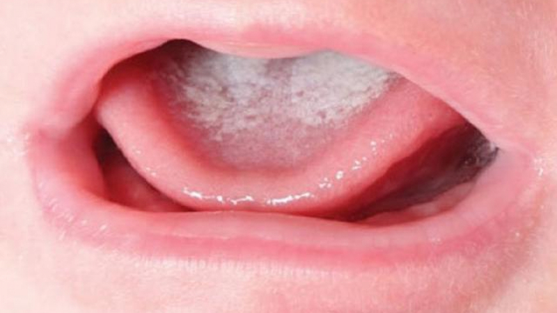Trẻ có thể bị tưa lưỡi do nhiễm nấm từ mẹ