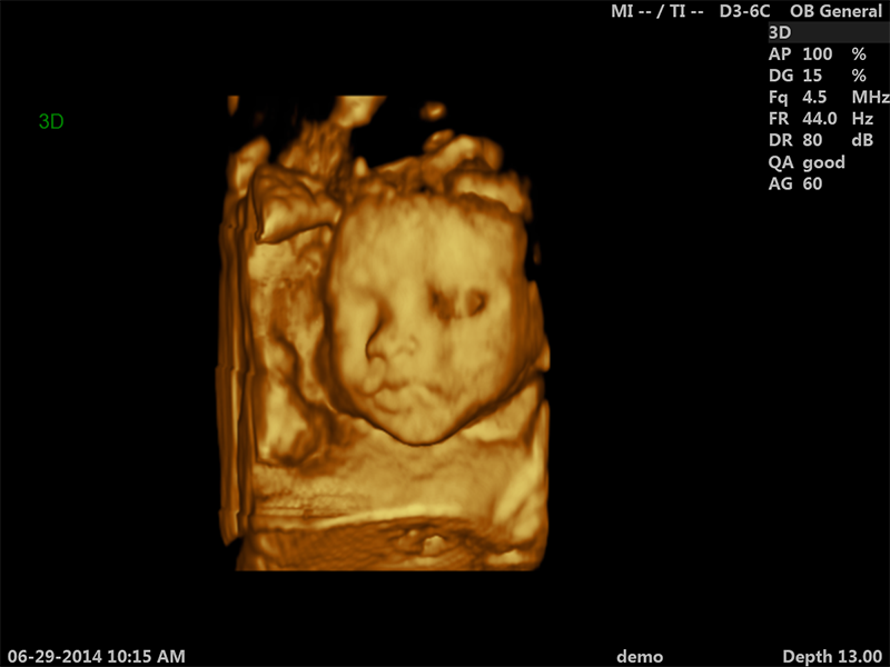 Siêu âm 3D là công nghệ hiện đại giúp cha mẹ có thể nhìn thấy hình ảnh con yêu trong bụng