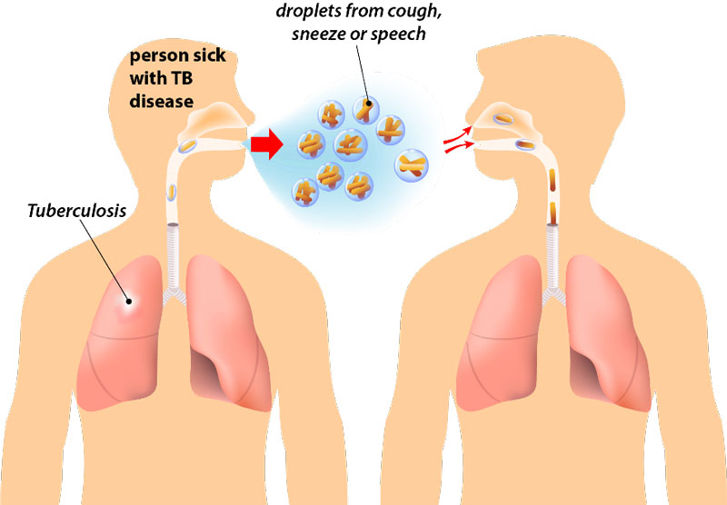 bệnh lao màng phổi