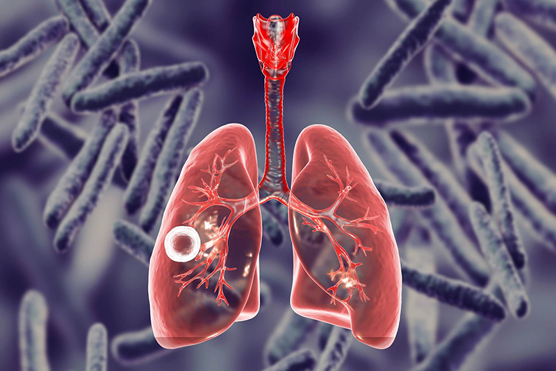Khoảng 40% bệnh nhân có biểu hiện ứ đọng dịch trong phổi xuất phát từ lao màng phổi