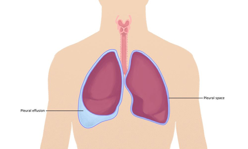 Hình ảnh mô tả tình trạng tích tụ dịch trong khoang phổi