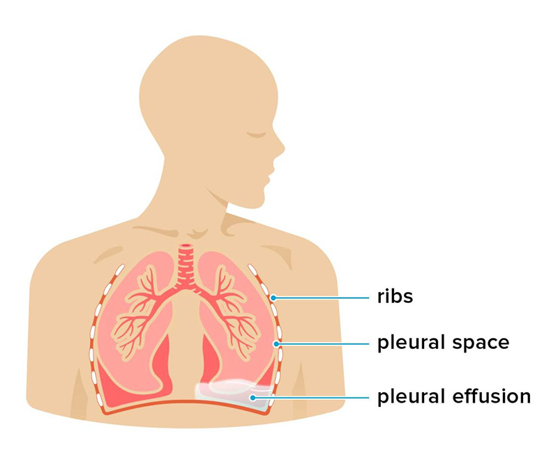 Hình ảnh mô tả tình trạng tràn dịch màng phổi