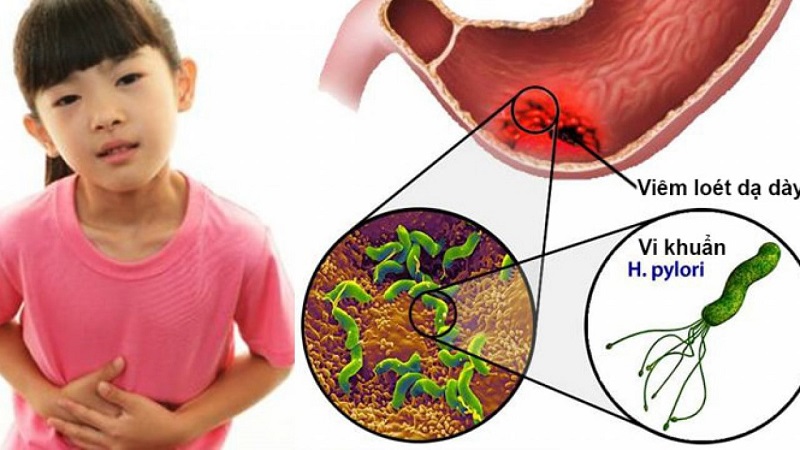 Vi khuẩn HP sinh sống và phát triển trong dạ dày người.