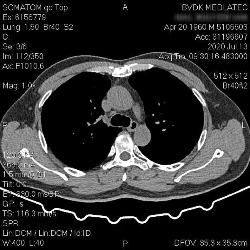 khạc đờm ra máu tươi nên đi chụp CT phổi
