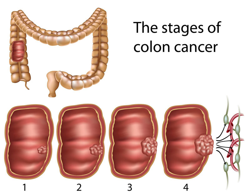 Bệnh ung thư đại tràng thường phát triển qua 4 giai đoạn chính