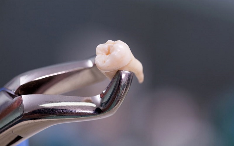 Nhổ răng khôn tại cơ sở y tế uy tín để tránh biến chứng không tốt