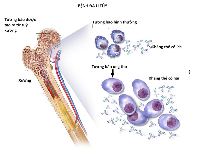Hình ảnh xương và tế bào của bệnh nhân đa u tủy