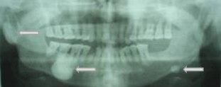 Hình ảnh X-quang của bệnh nhân có nhiều tổn thương nang xương hàm cả hai bên