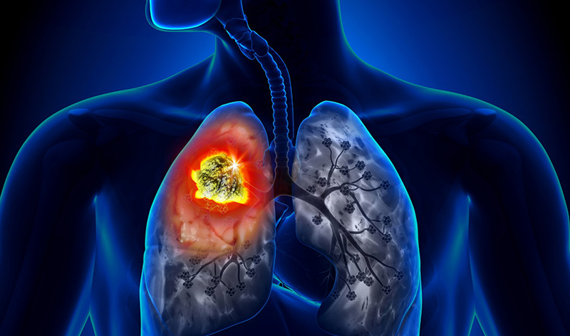 Người mắc ung thư phổi có thể xuất hiện các cơn ho có đờm dai dẳng