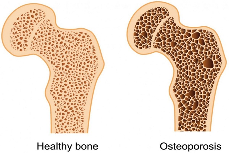 Hình ảnh xương khỏe mạnh và tình trạng loãng xương