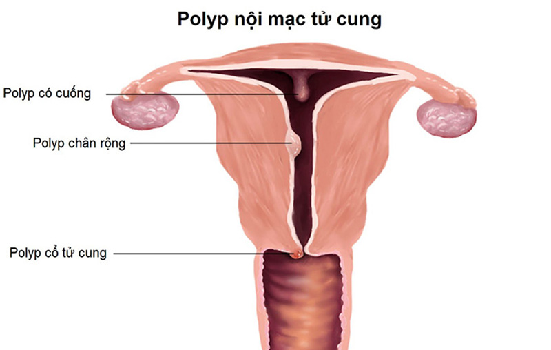 Polyp hình thành do sự phát triển của các tuyến hoặc mô tế bào đệm nội mạc tử cung 
