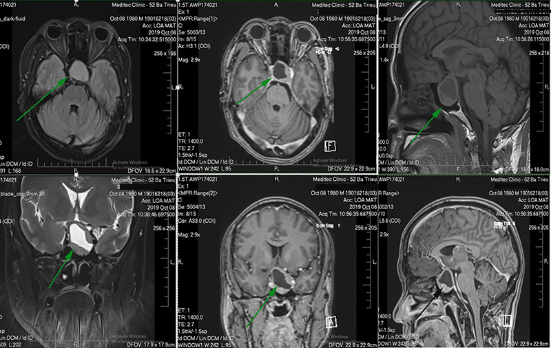 Có thể phát hiện u tuyến yên thông qua chụp MRI
