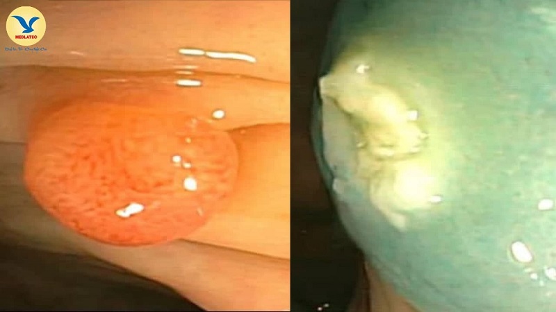 Hình ảnh polyp trước cắt (trái) và sau cắt (phải). 
