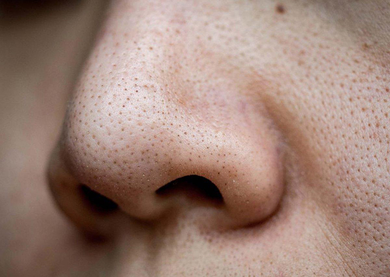 Những chấm nhỏ li ti xuất hiện trên mặt là biểu hiện của mụn đầu đen nhô lên trên bề mặt da