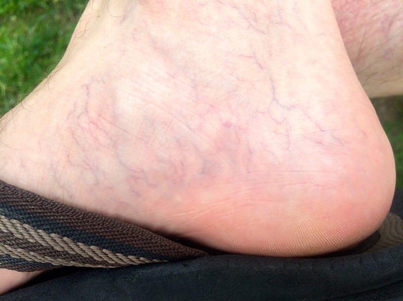 Một trong những dấu hiệu của suy giãn tĩnh mạch chân là các đường tĩnh mạch nổi rõ trên da