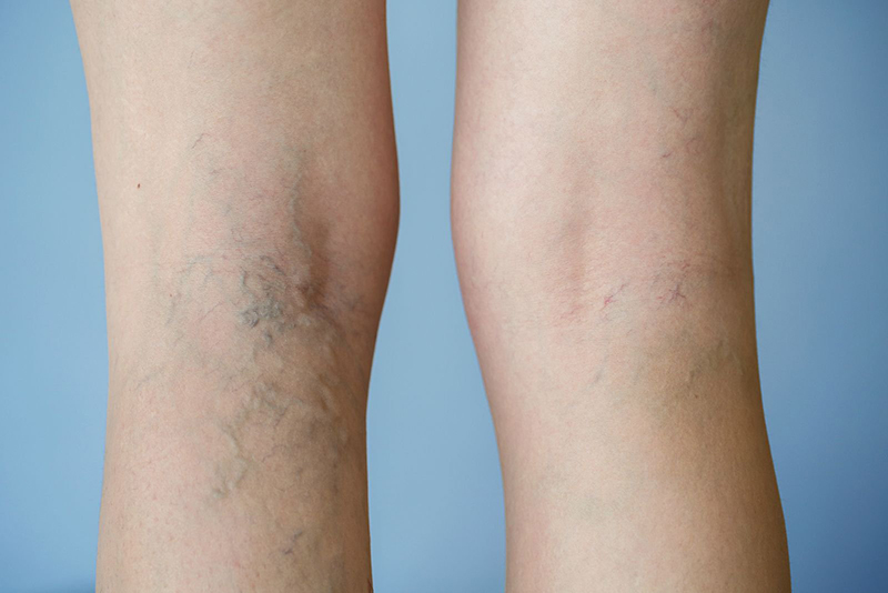 Triệu chứng giãn tĩnh mạch chân là các đường vân màu tím hoặc xanh xuất hiện trên chân