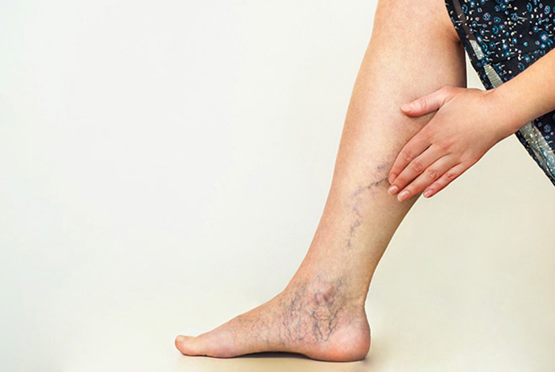 Một trong những triệu chứng giãn tĩnh mạch là hiện tượng sưng phù bàn chân