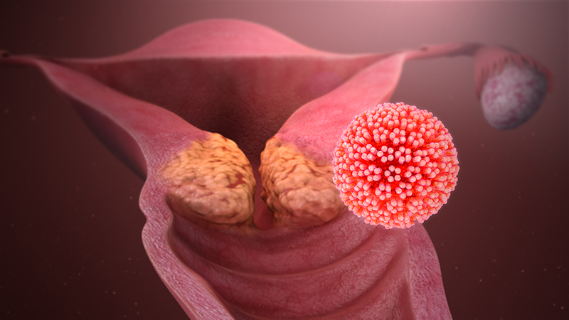 Virus HPV làm tăng khả năng mắc bệnh ung thư cổ tử cung ở phụ nữ