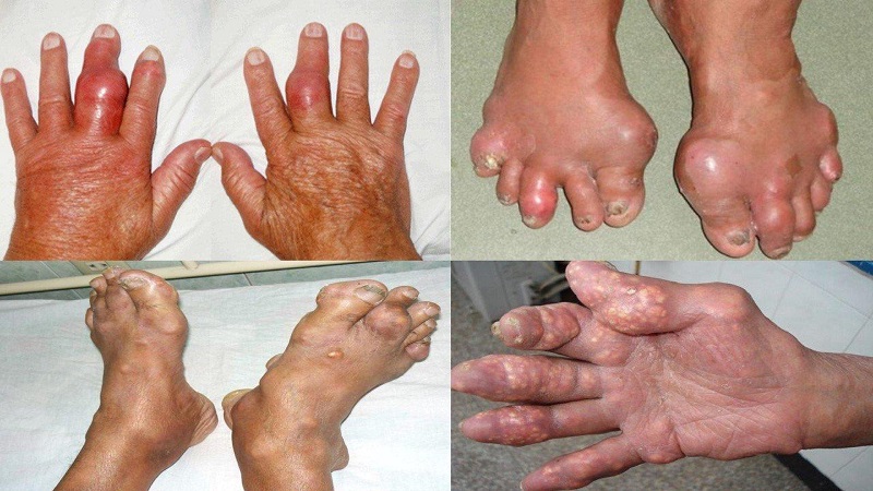 Biến dạng các khớp bàn chân, tay do khối tophi nổi dưới da ở bệnh nhân gout 