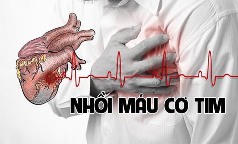 Bệnh nhồi máu cơ tim thường gây ra cơn đau lưng bên trái, khó thở