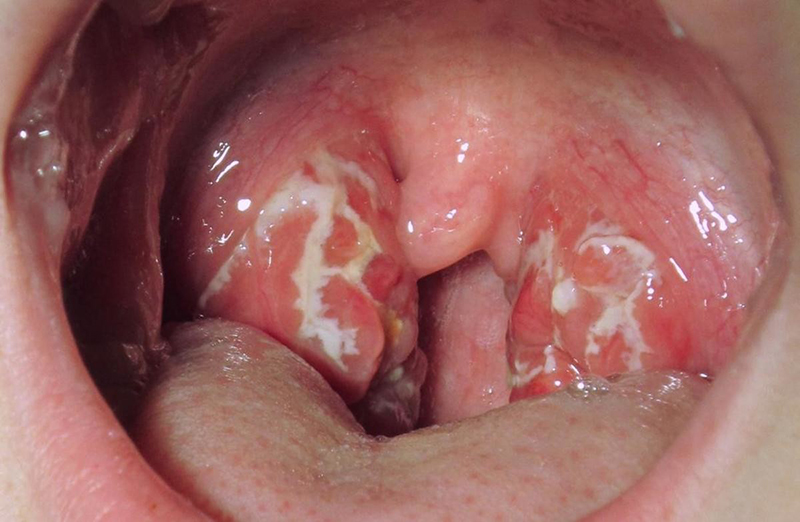 Nhiễm virus HPV có thể gây ung thư khoang miệng nếu không chữa trị sớm
