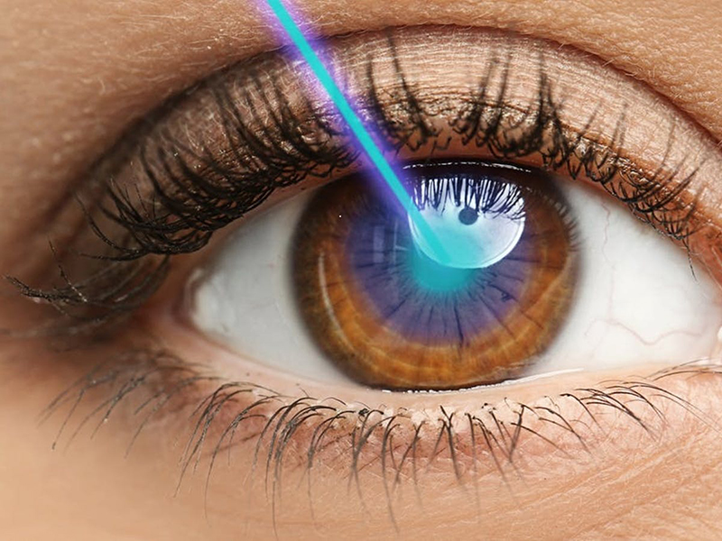 Phẫu thuật mắt cận thị bằng tia Laser Excimer được đánh giá là biện pháp tối ưu và an toàn 