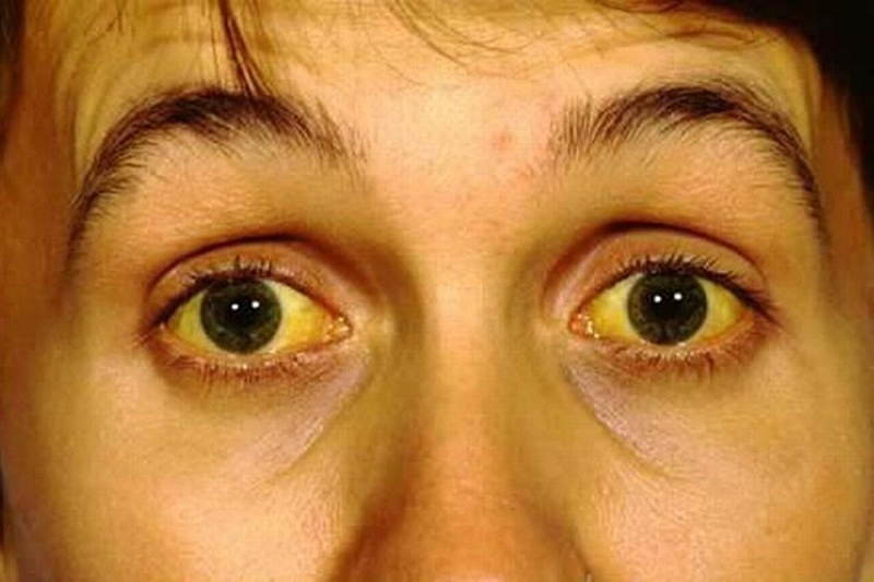 Vàng mắt là một trong 8 triệu chứng chính của sỏi mật