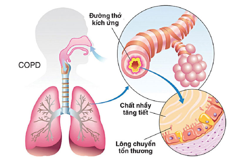 điều trị COPD bệnh phổi tắc nghẽn mạn tính