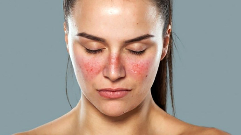 Cơ quan chịu ảnh hưởng đầu tiên của lupus ban đỏ thường là da