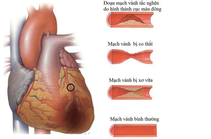 bệnh thiếu máu cơ tim thường do hẹp tắc mạch vành