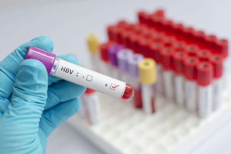 Xét nghiệm sàng lọc HBsAg cho biết một người có bị viêm gan B hay không