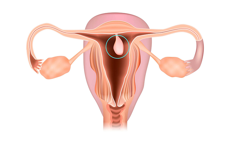 Sự hình thành khối polyp cổ tử cung hay nội mạc tử cung có thể gây ra những rối loạn chu kỳ kinh nguyệt