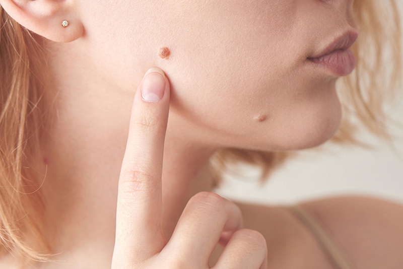 Chú ý nốt ruồi của bạn vì đây có thể là dấu hiệu nhận biết ung thư da