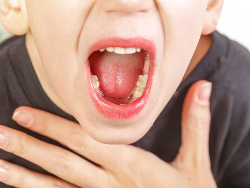 Triệu chứng điển hình của viêm họng liên cầu là đau rát vùng hầu họng 