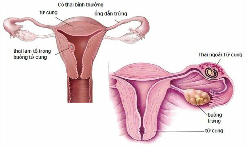 Nội soi ổ bụng giúp chẩn đoán chính xác thai ngoài tử cung