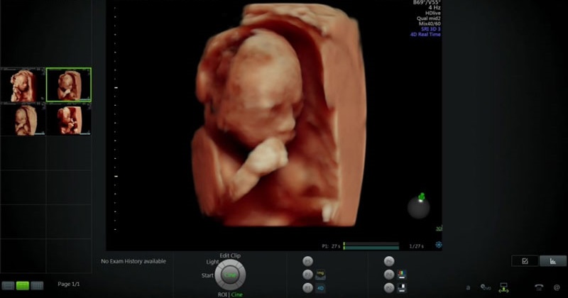 Siêu âm 4D cho thai nhi nhìn thấy cả cử động nhỏ nhất của bé yêu