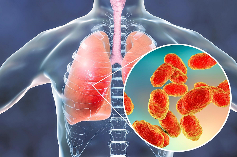 Viêm màng phổi là một trong những nguyên nhân gây nên tràn dịch màng phổi
