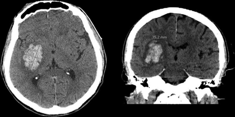 Xác định tình trạng xuất huyết não qua hình ảnh chụp CT scan