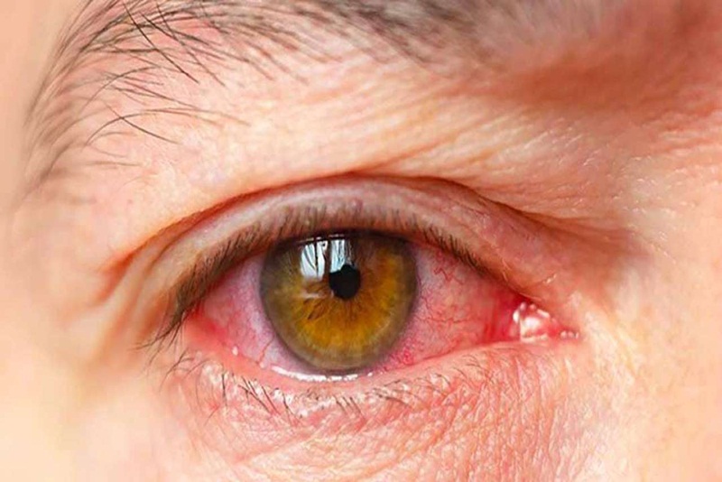 triệu chứng viêm mống mắt