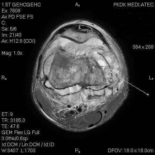 Hình ảnh chụp cộng hưởng từ MRI khớp gối phải của bệnh nhân.