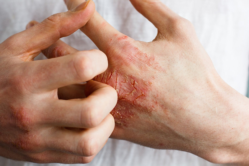 Viêm da là một trong những bệnh lý đang trở nên vô cùng phổ biến trong xã hội hiện nay