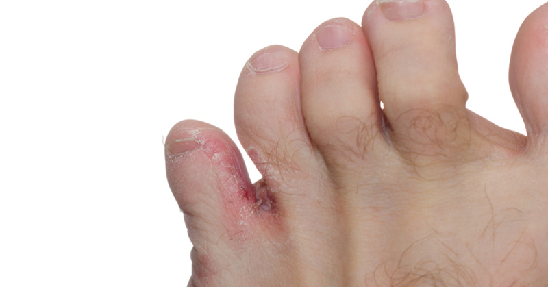 Nấm kẽ chân là một bệnh lý về da với các triệu chứng vô cùng khó chịu