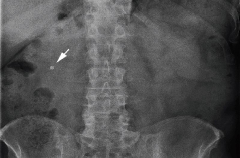 Hình ảnh chụp X-quang giúp xác định vị trí sỏi thận